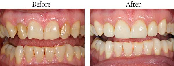Paradise Before and After Invisalign