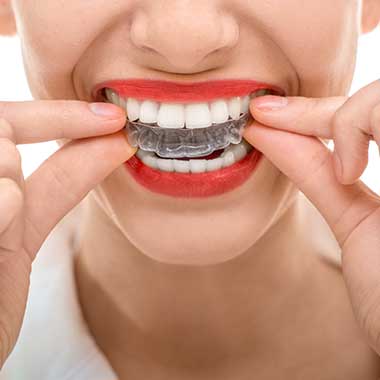Invisalign