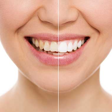 Teeth Whitening