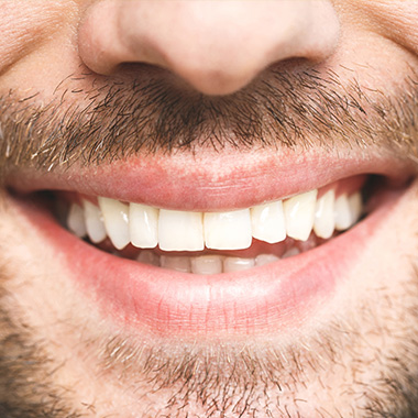 Implant Restorations