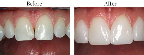 Green Valley South Before and After Teeth Whitening